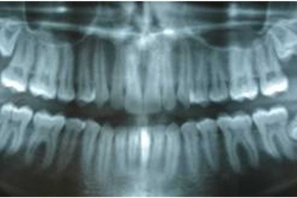 wisdom teeth