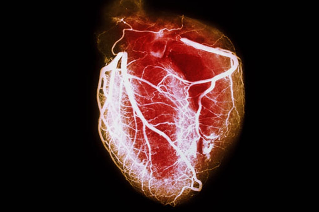 PRinc rm arteriogram of healthy heart