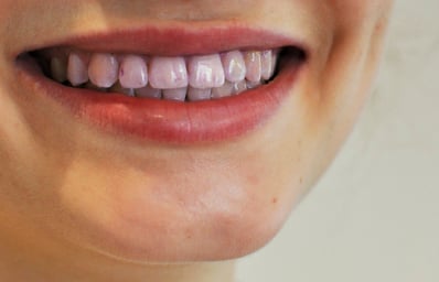 purple teeth e1429538046687