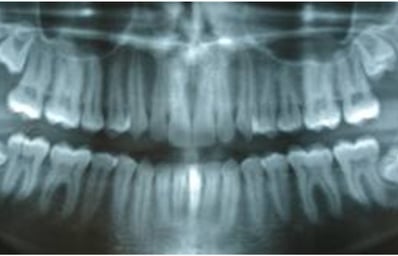 wisdom teeth