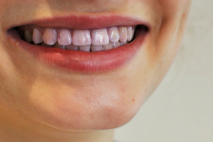 purple teeth e1429538046687