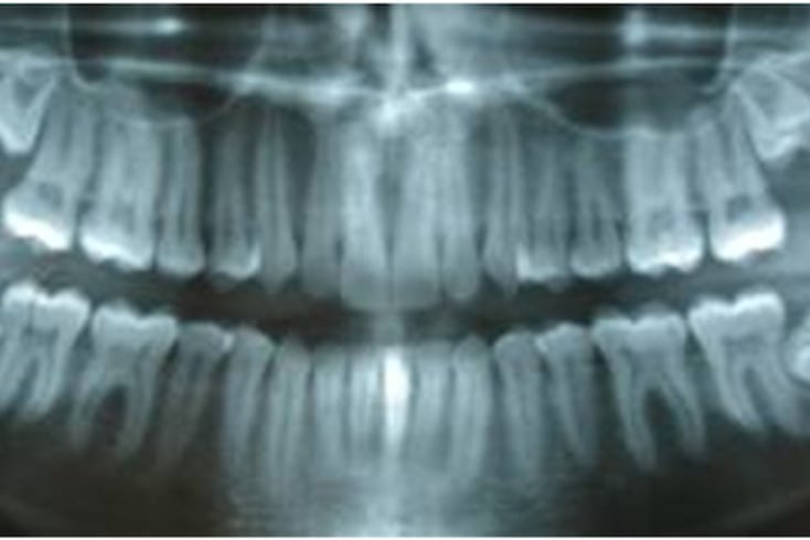 wisdom teeth
